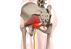 Deep Gluteal Pain Syndrome