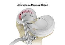 Meniscal Repair Surgery