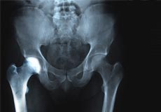 Transient Osteoporosis of the Hip